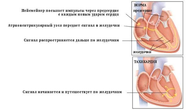 orta - 679 Источник: https://www.drugs.com/health-guide/tachycardia.html