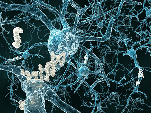 shutterstock_111506315_alzheimer