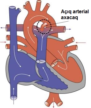 Açıq arterial axacaq