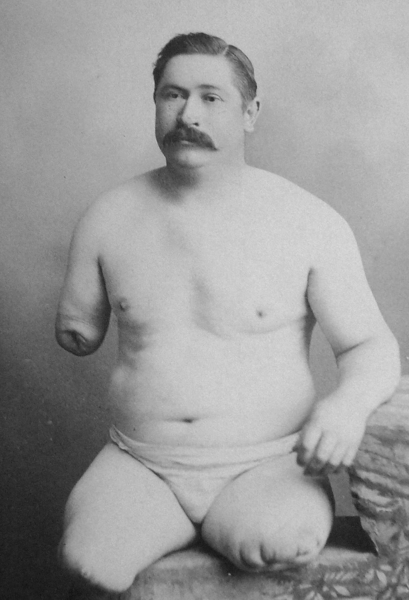 Amputasiya