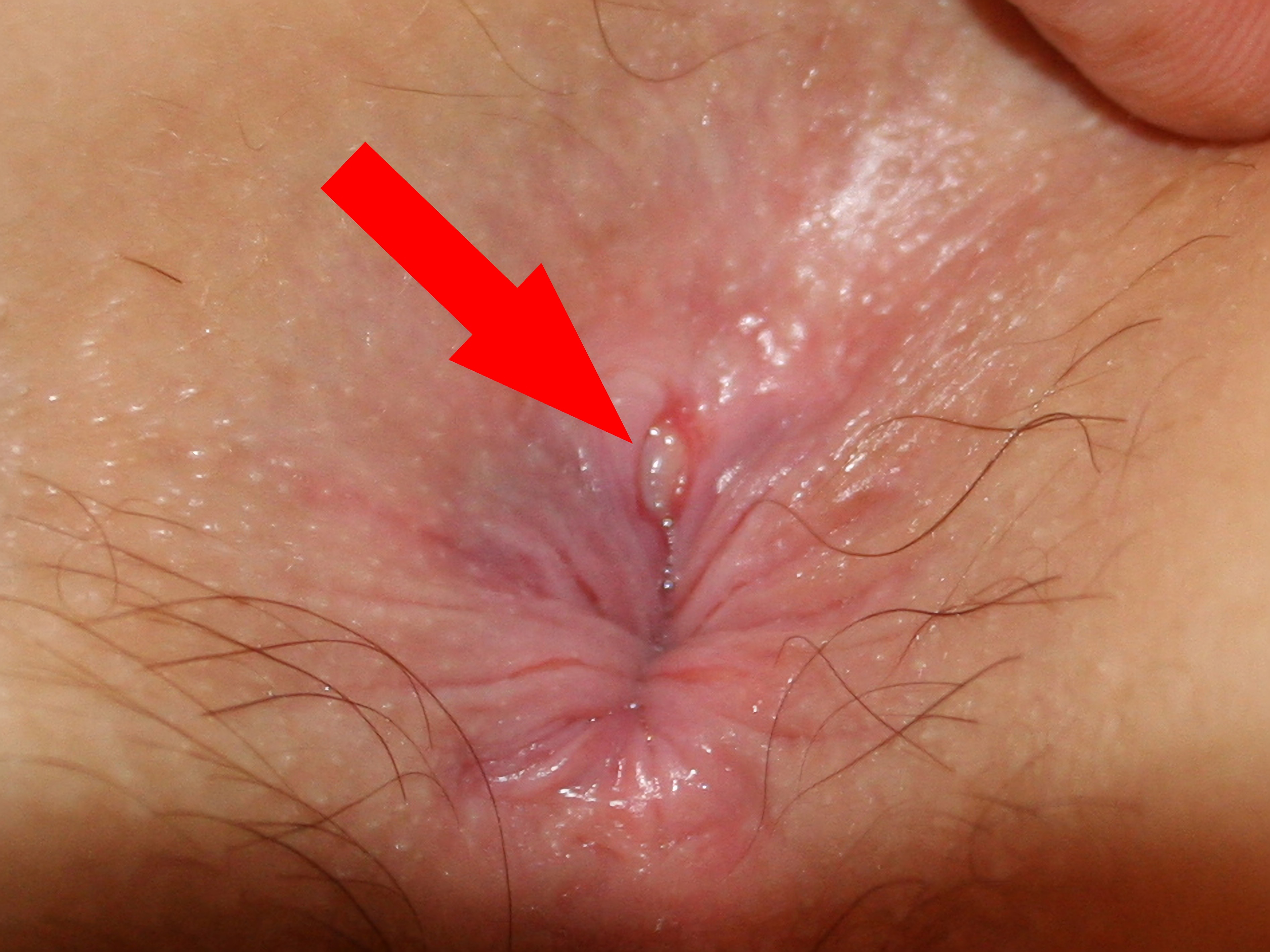 Anal fissur