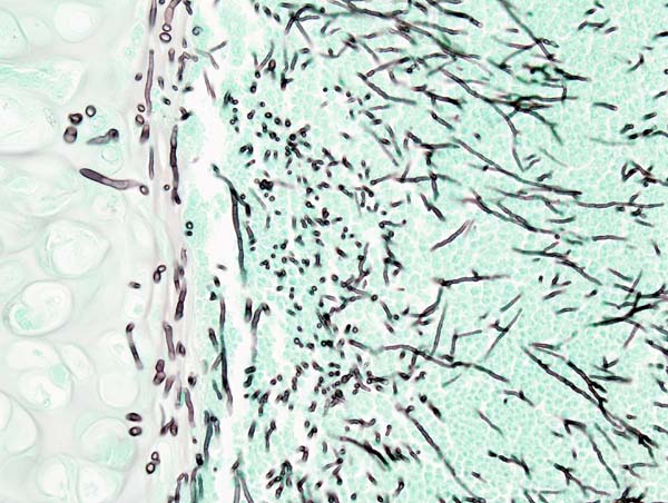 Aspergilloz