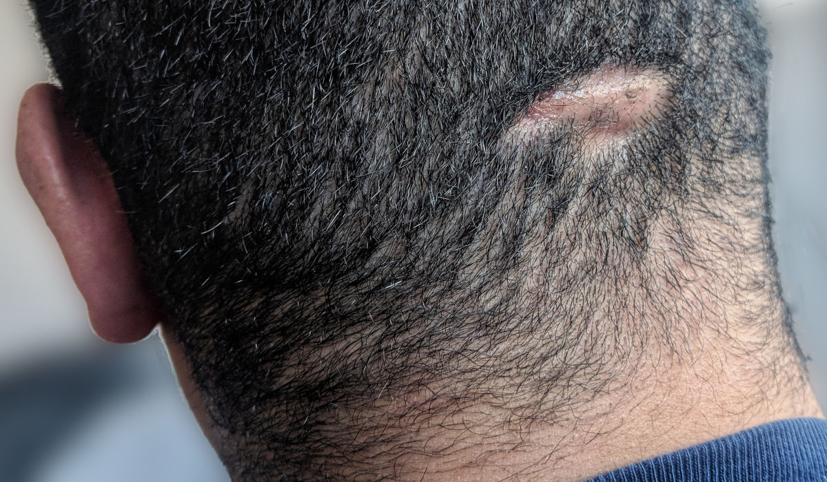 Çapıqlı alopesiya