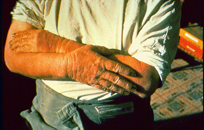 Dermatit
