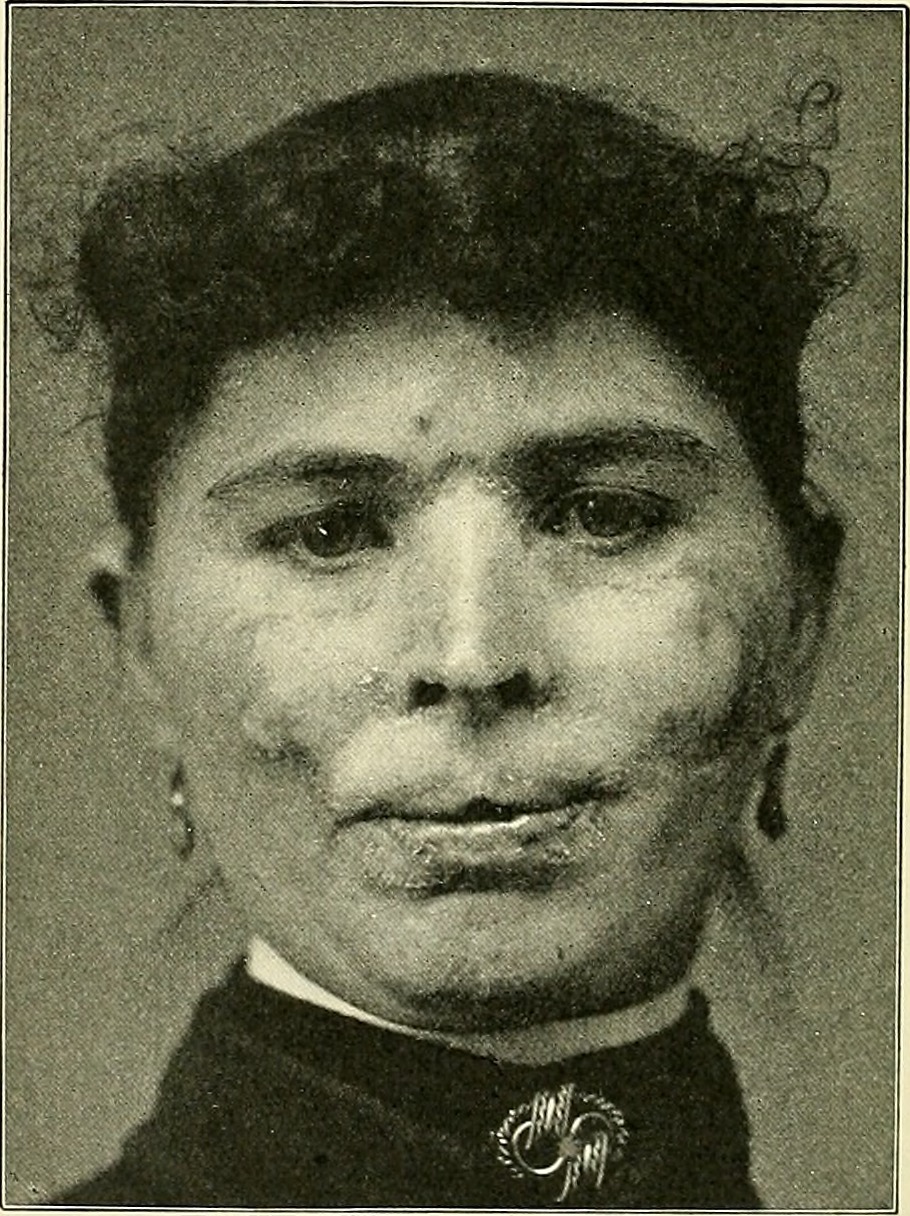 Diskoid lupus