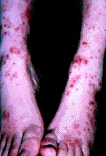 Əllənən purpura