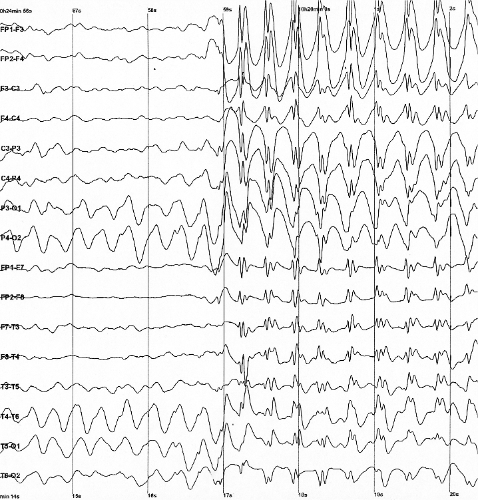 Epilepsiya