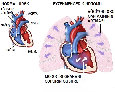 Eyzenmenger sindromu