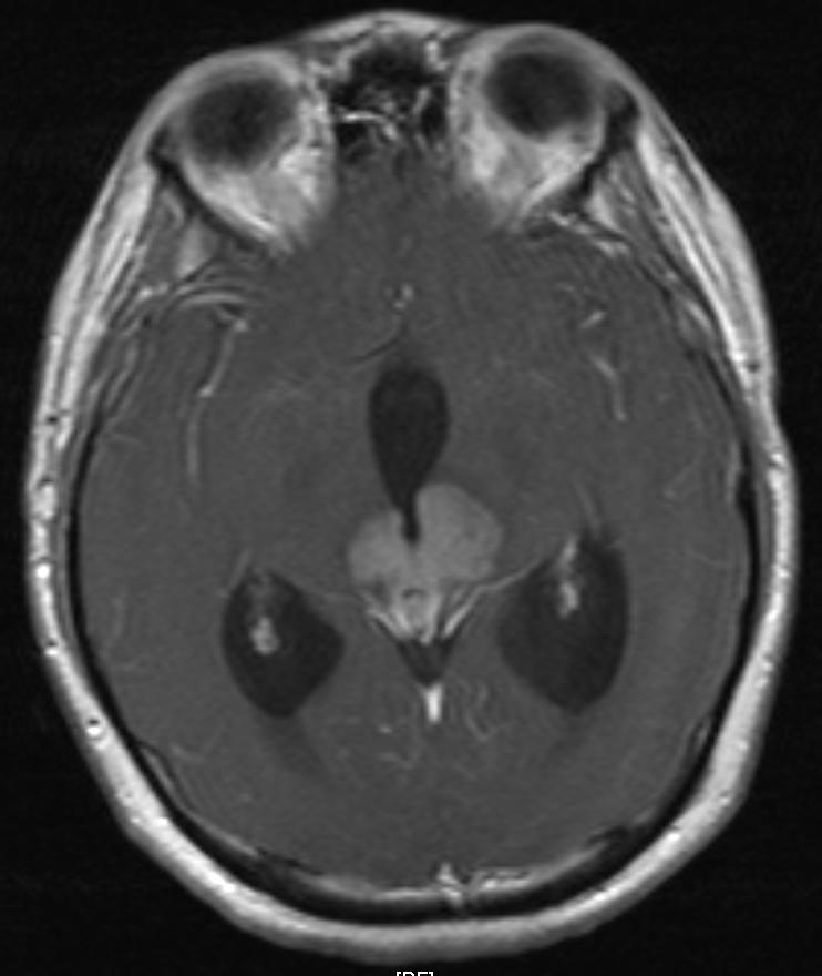 Germinoma