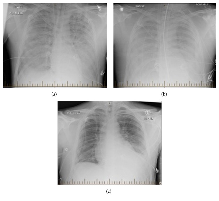 Hantavirus infeksiyası