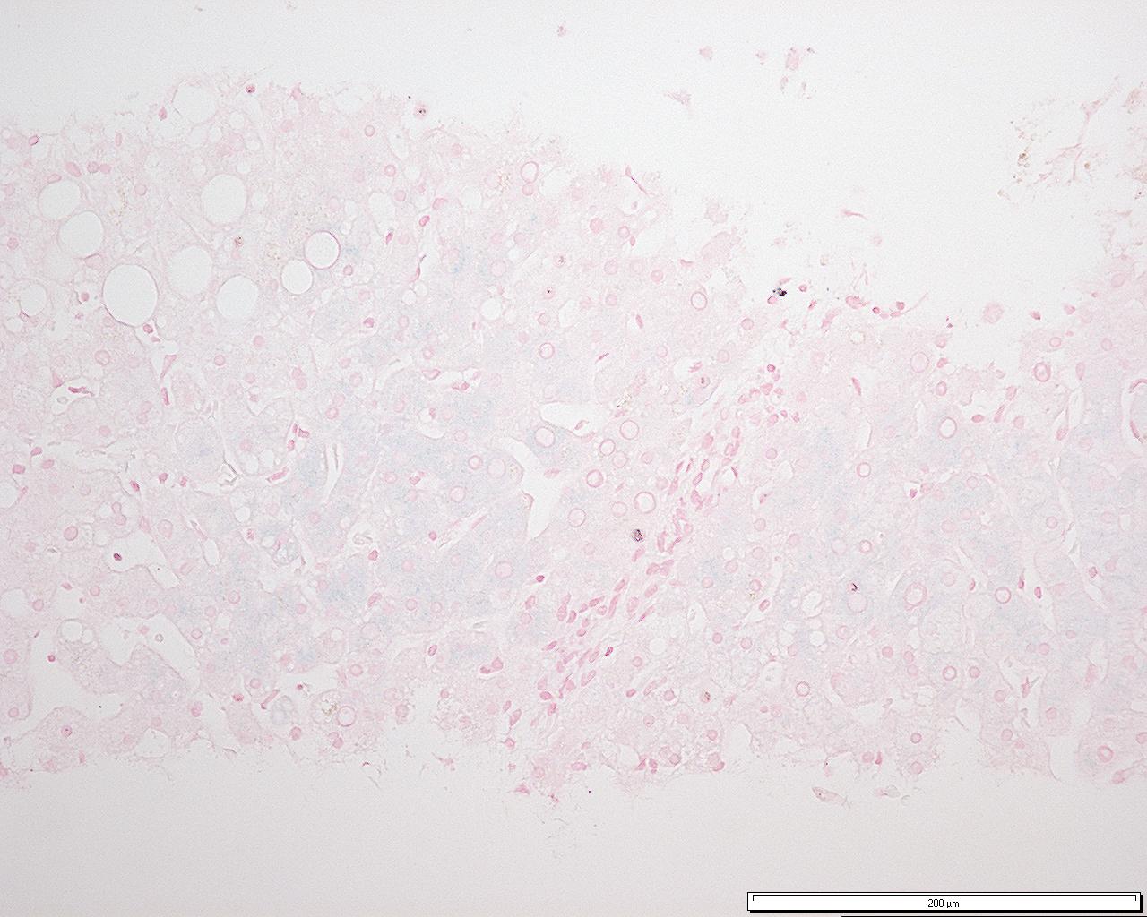 Hemoxromotoz