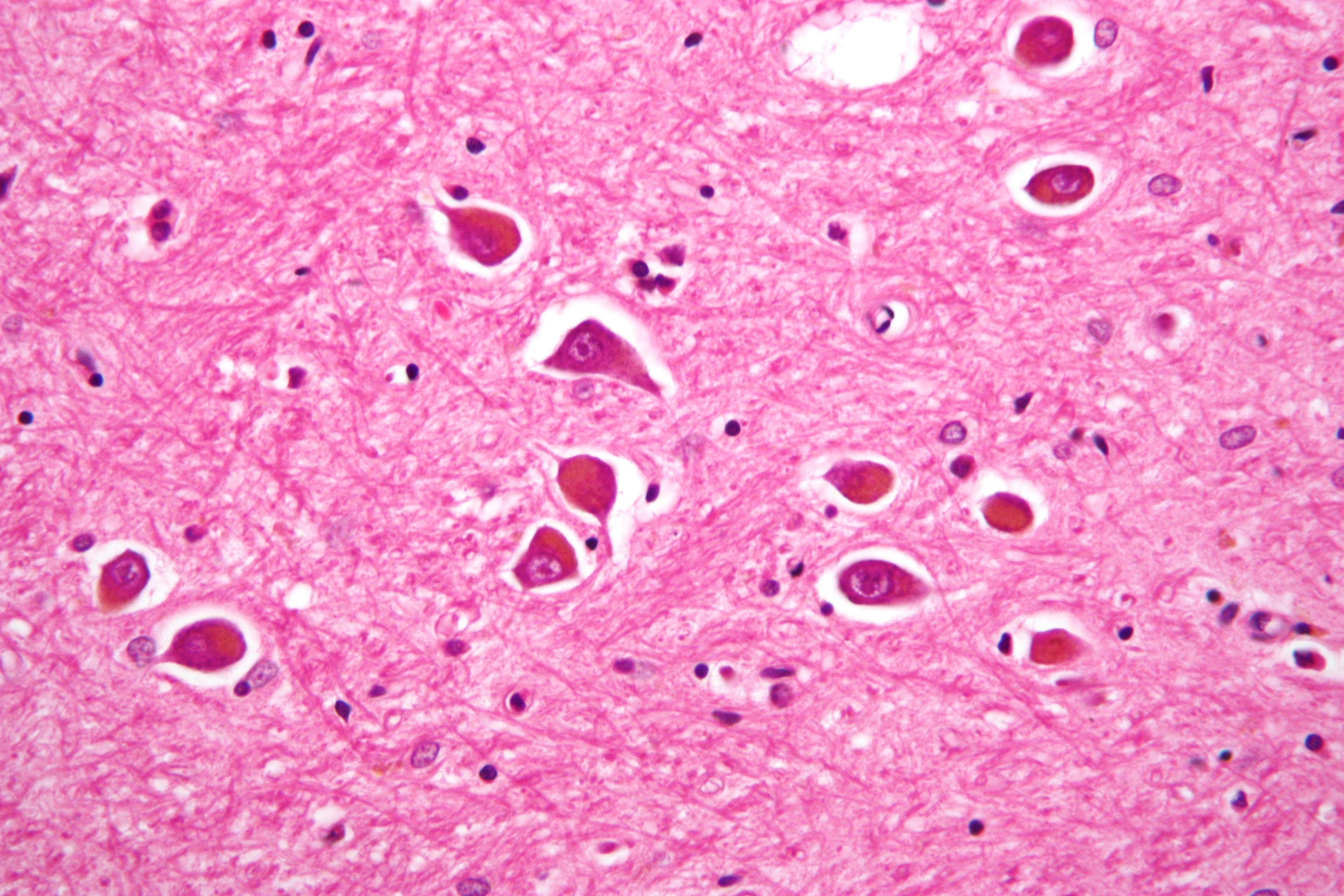 Hepatik ensefalopatiya