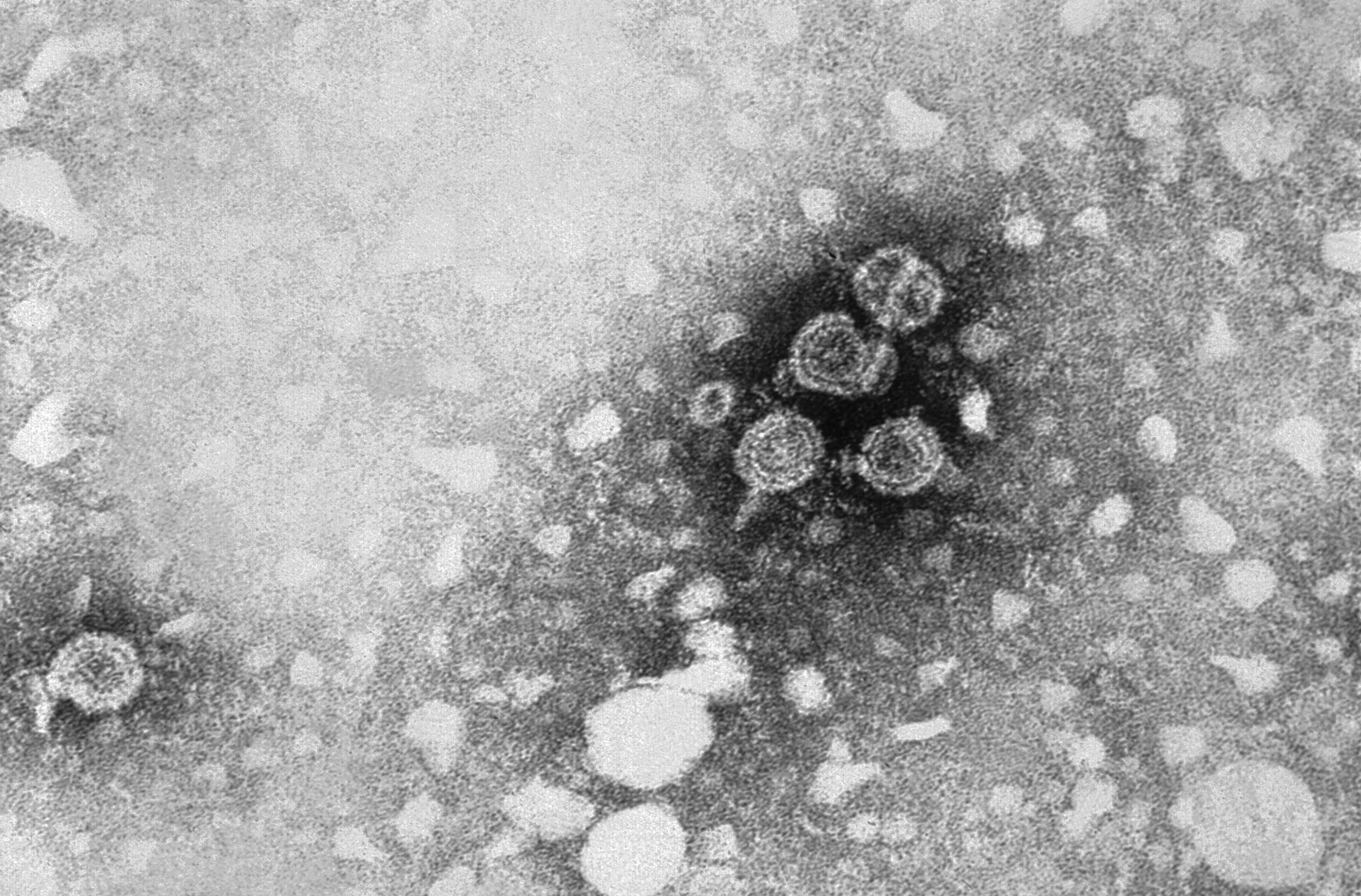 Hepatit B
