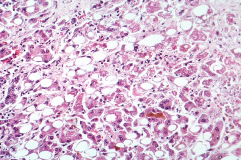 Hepatit
