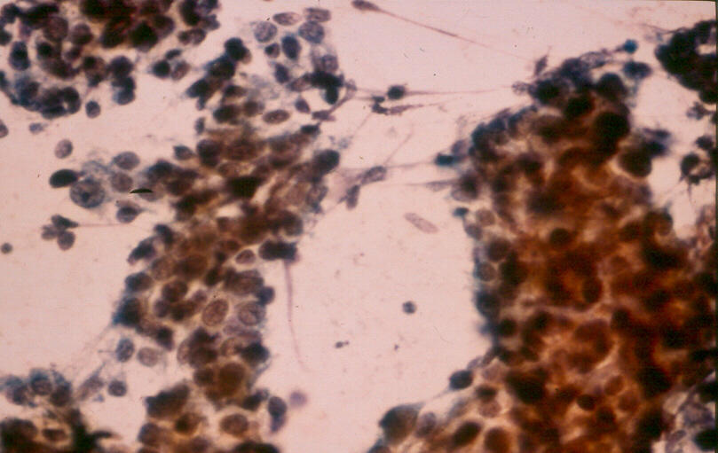 Hepatoblastoma