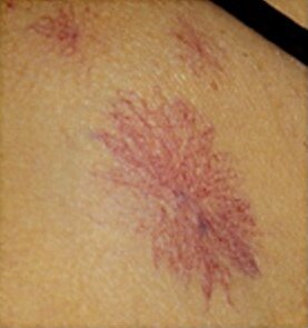 Hörümçək angioma