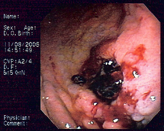 Limfoma