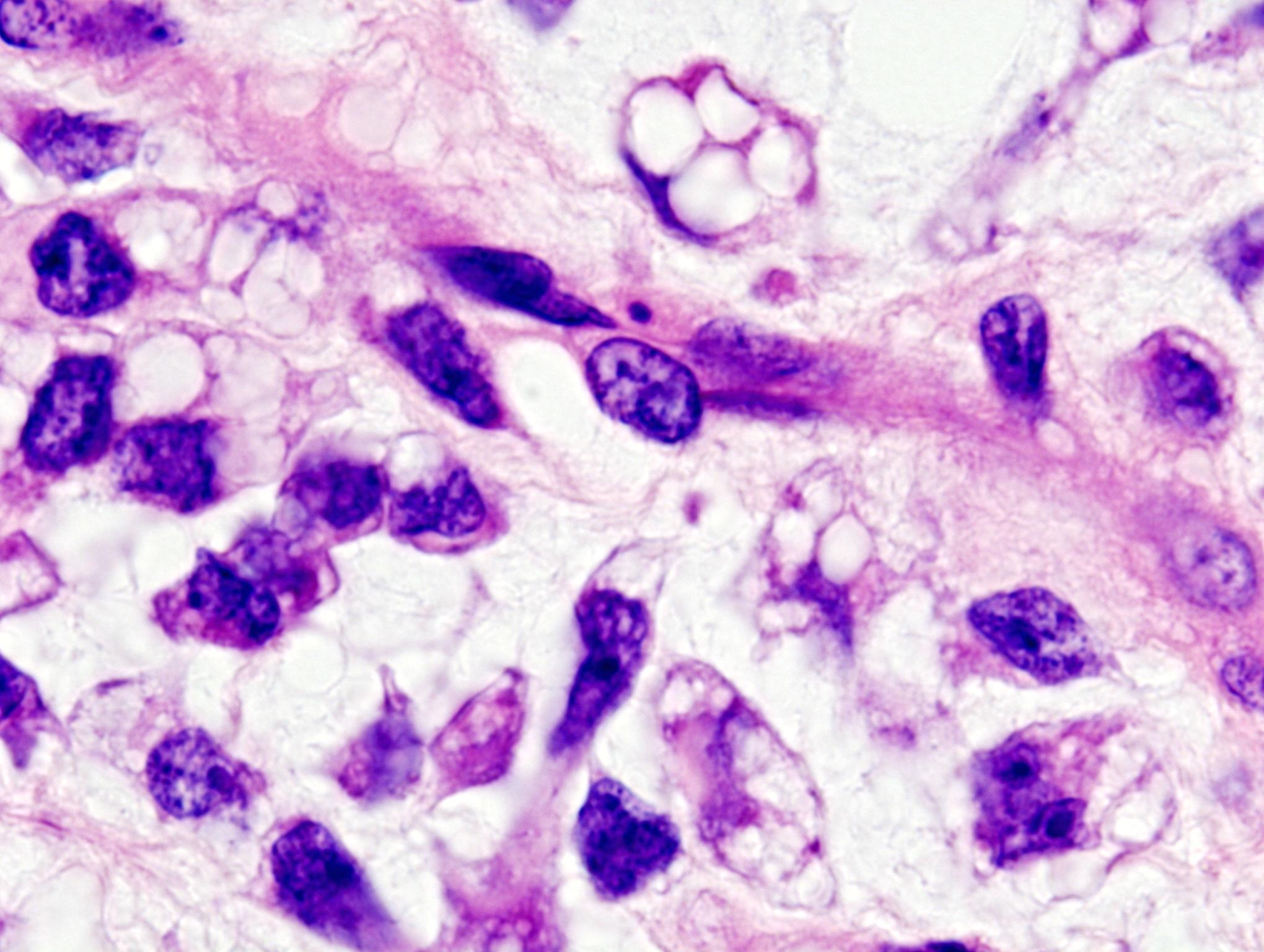 Liposarkoma