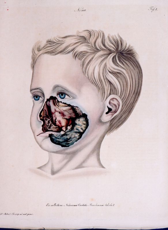 Noma (xəstəlik)