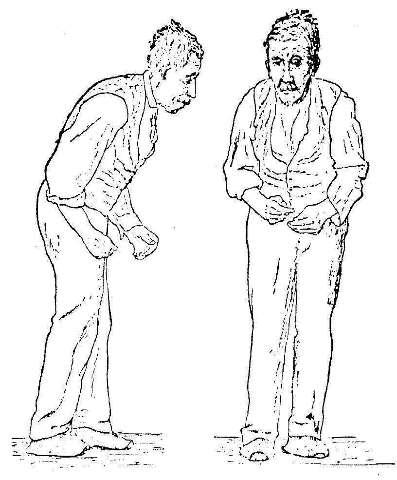 Parkinson xəstəliyi