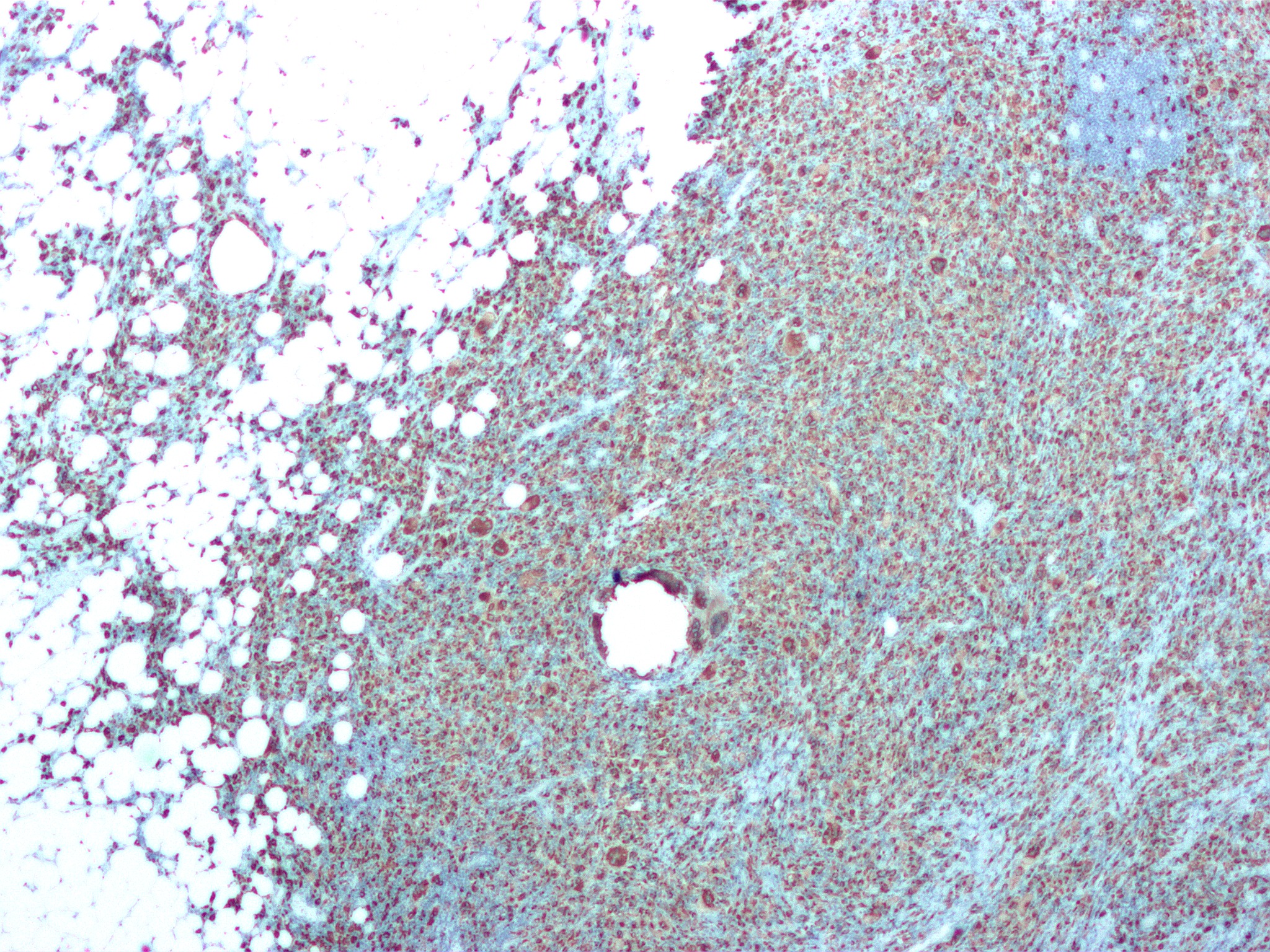Pielonefrit