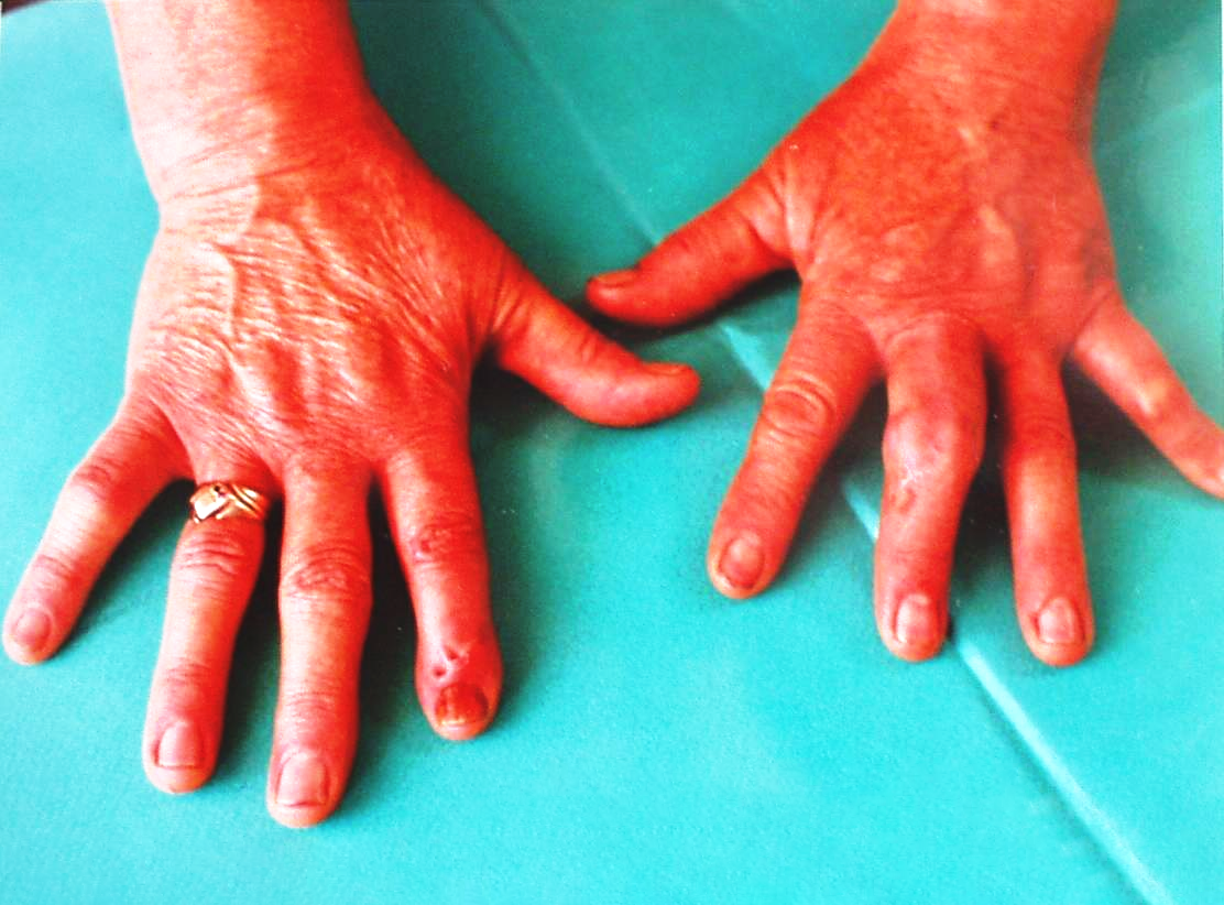 Psoriatik artrit