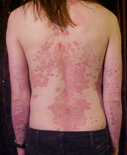Psoriaz