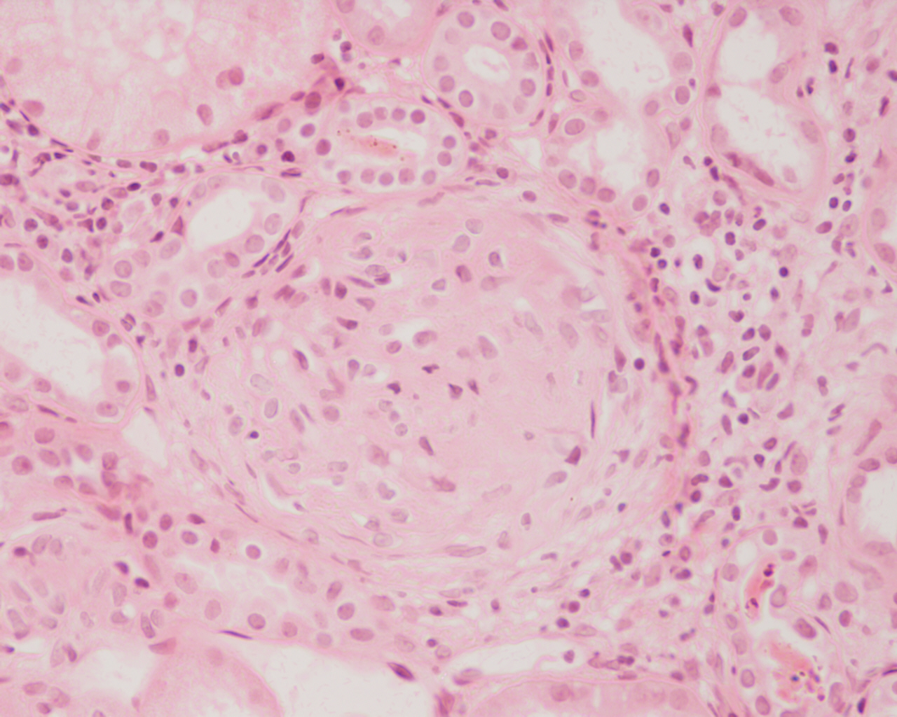 Qlomerulonefrit