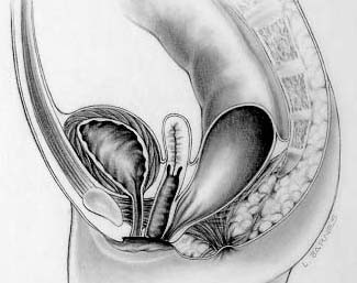 Rektovaginal fistul
