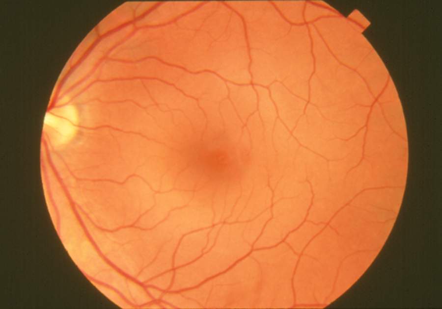 Retinopatiya