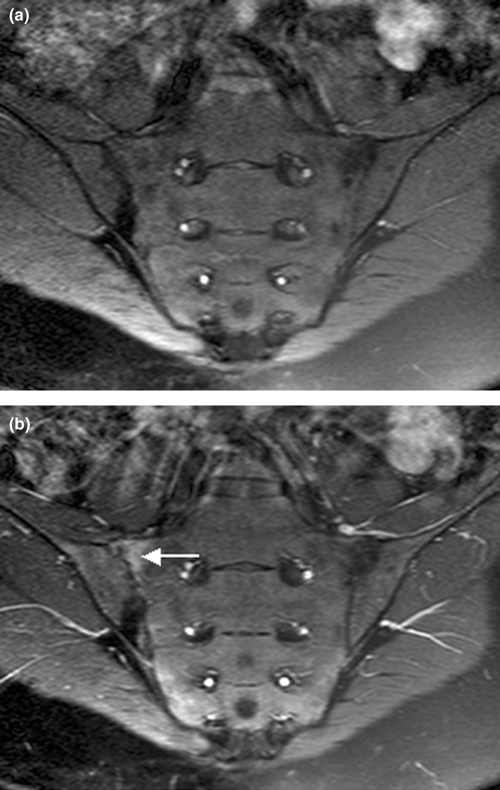 Sacroiliitis