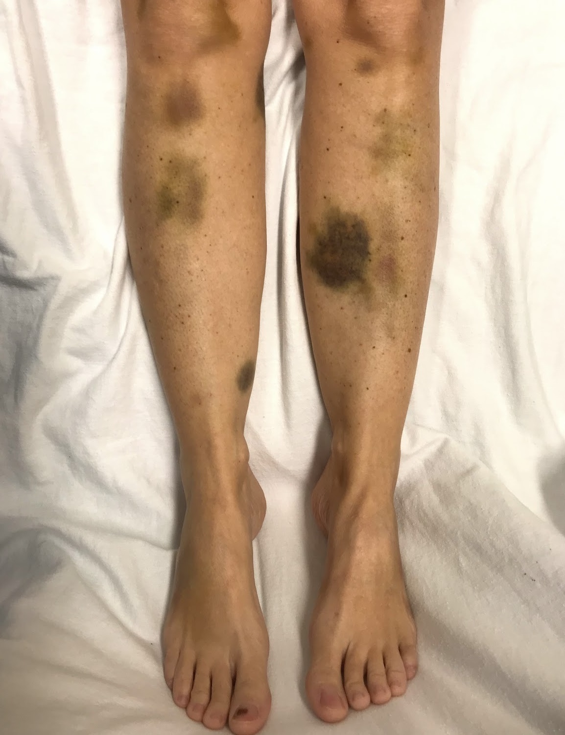 Trombotik trombositopenik purpura